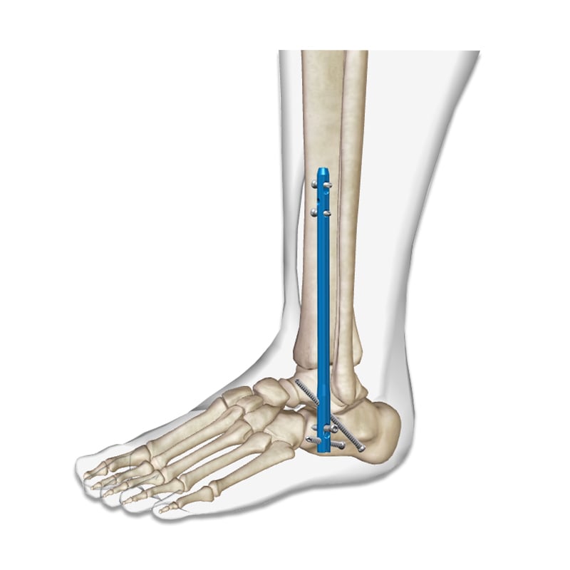 Distal Tibial Interlocking Intramedullary Nail / Ankle Fusion Nail